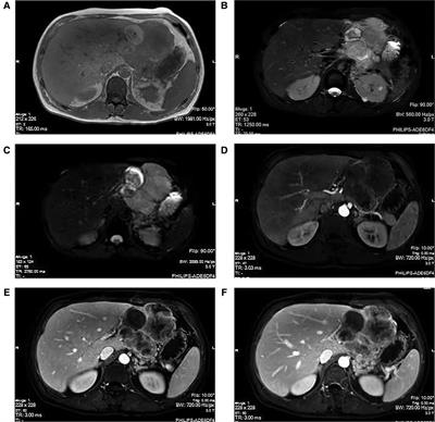 Gastric infiltration of hepatic sarcomatoid carcinoma: A case report and literature review